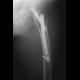 Intertrochanteric hip fracture, osteosynthesis, dynamic screws: X-ray - Plain radiograph